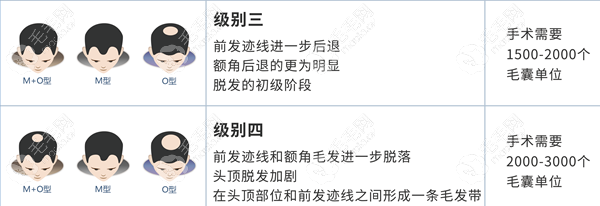 脱发等级图3——4级