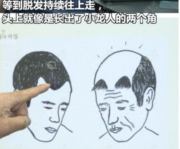 先天/后天额头高植发后老了变小龙人