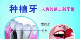 皓圣、杰美、百康、3I等美國種植牙的價格是多少錢一顆
