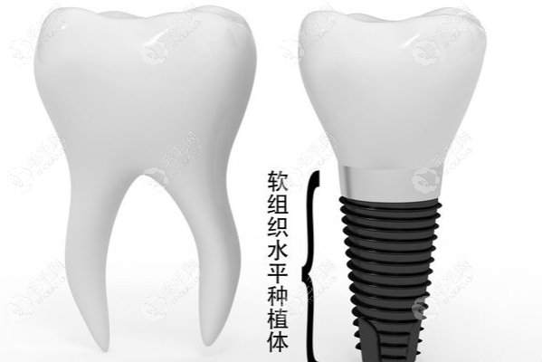 软组织水平种植体