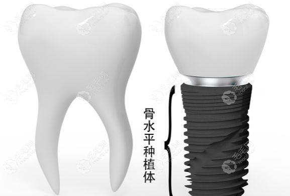 骨水平种植体