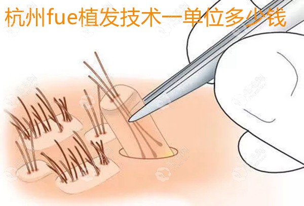 点播杭州fue植发技术一单位多少钱,还有微针/FUT手术费用齐聚