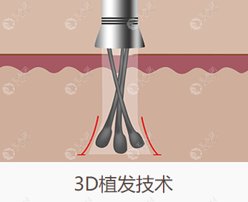 新生植发的3d主打技术