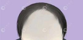 植發(fā)5000毛囊需要多久完成?想知道植發(fā)后大概要請(qǐng)假幾天