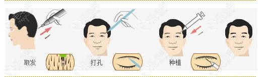 不剃发植眉过后取发区疼几天?恢复的话多久可以洗头?