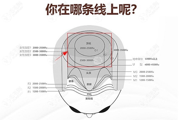 植发3000毛囊有多大面积