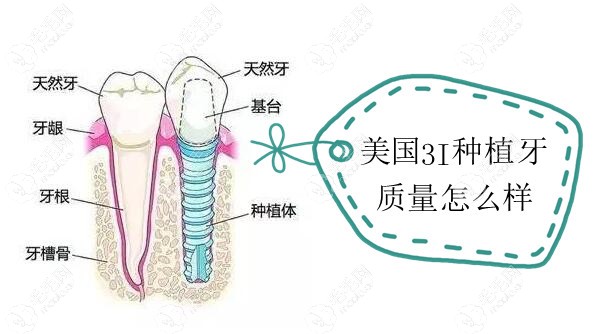 美国3I种植牙是什么材料