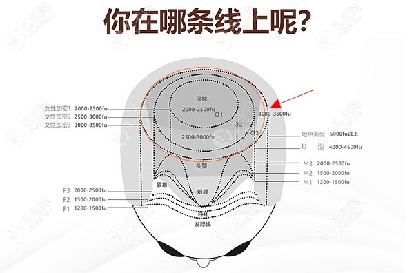 植发3500毛囊单位面积图