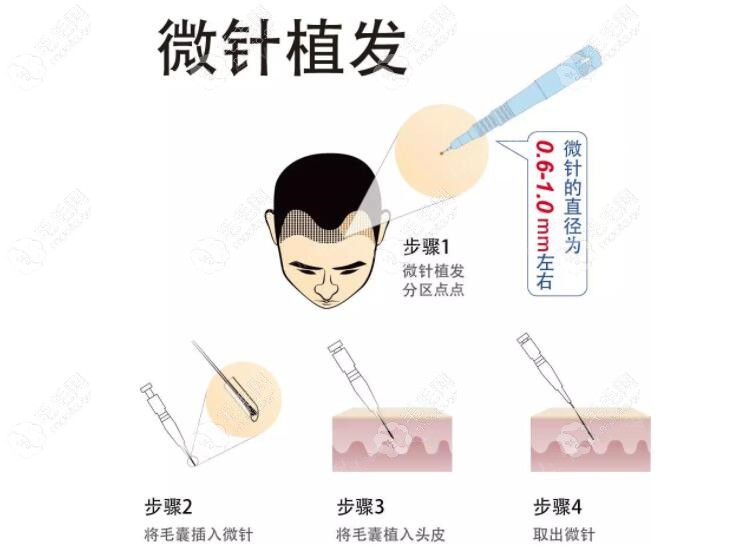 微针植发的特点