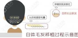 植發(fā)3000毛囊和3500單位的對比圖,看差500毛囊差多大面積