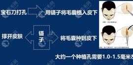 湖南永州植发的价格一般是多少钱?永州头发移植费用表走1份