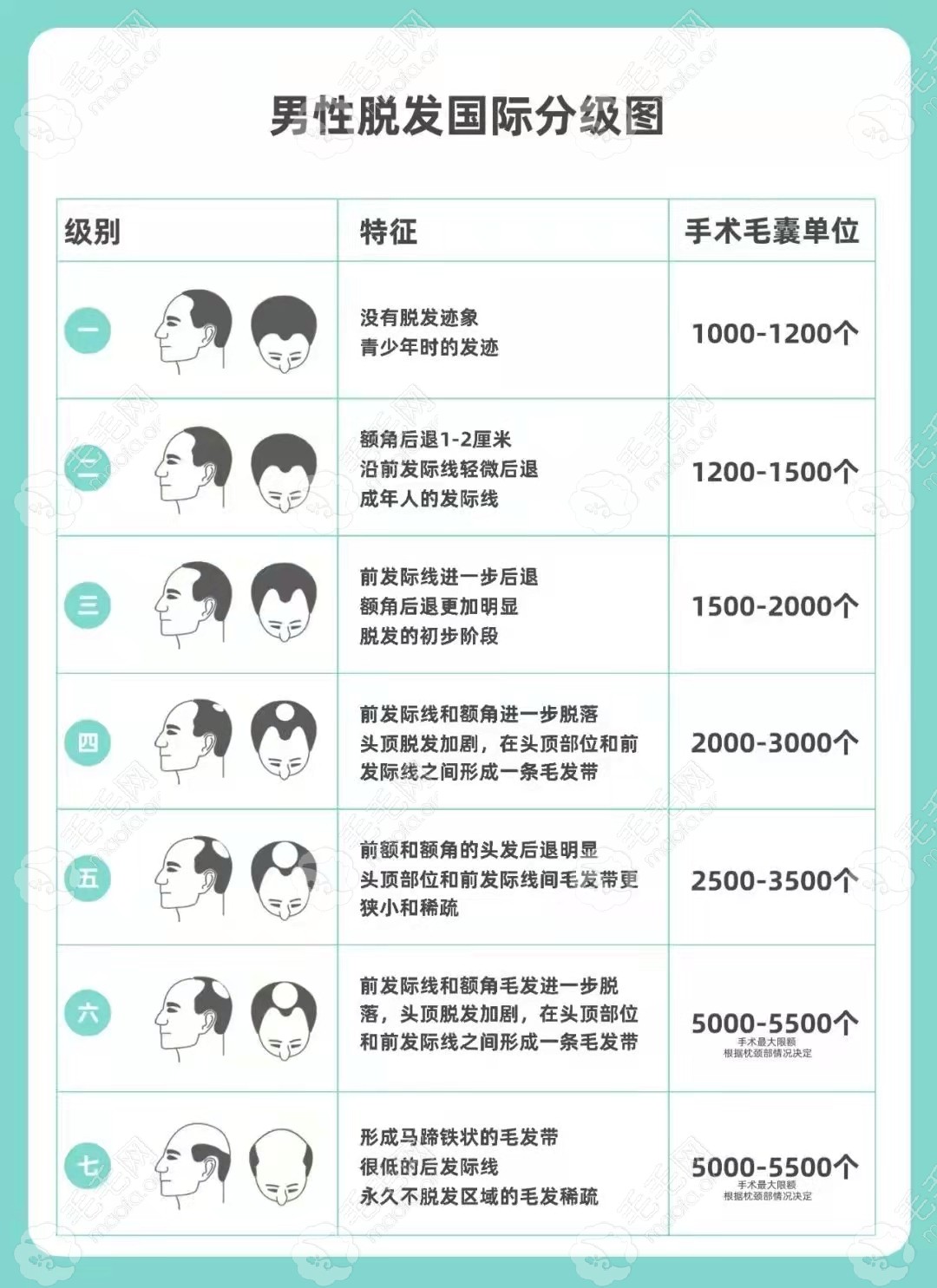 五级脱发种植多少单位能盖住头皮,3000单位够不够?