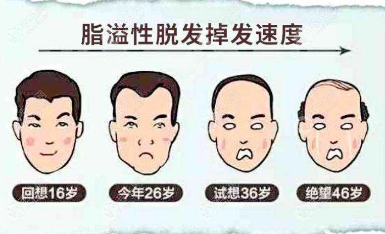 脂溢性脱发速度