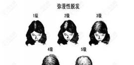 因弥漫性、遗传性、脂溢性脱发，植发后还会再脱吗