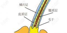植发20天毛囊能被抠出来吗?有人说植发22天毛囊抠掉了