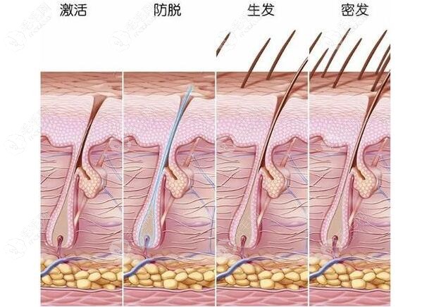 毛囊激活再生疗法是什么