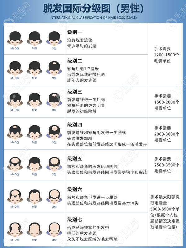 枣庄M型发际线植发的价格