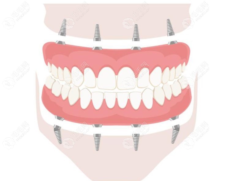 allon4全口种植牙示意图