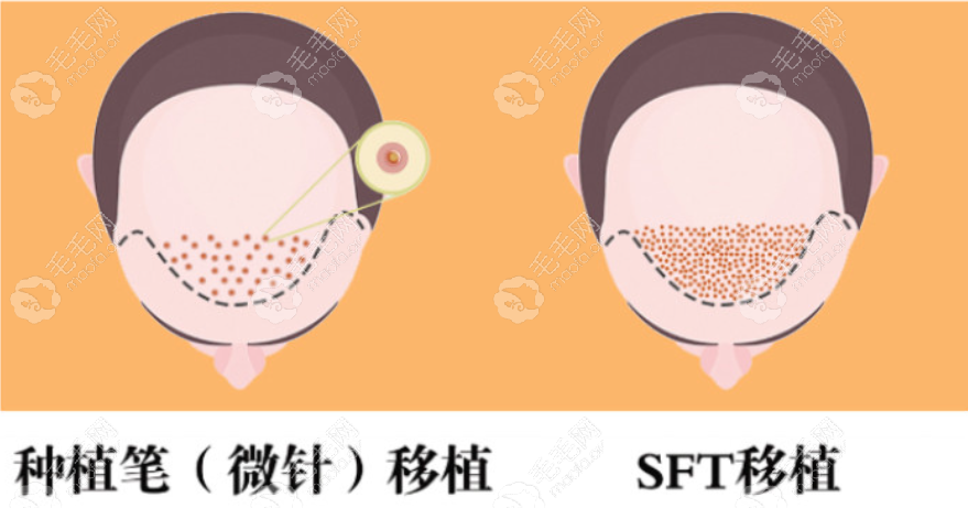 北京中德植发修复的sft技术