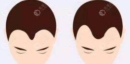 可对照m型脱发程度表来判断自己是不是m型脱发