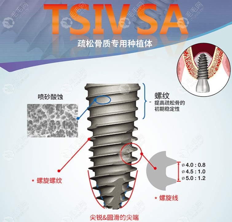 韩国奥齿泰ts4SA相关特性及适应症状