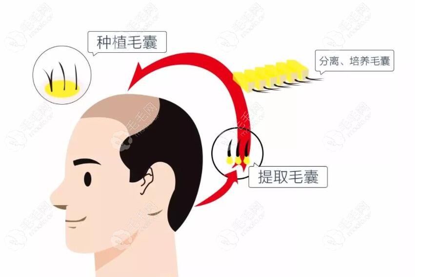 通过植发解决脱发问题