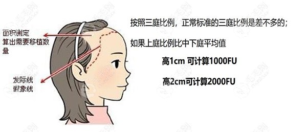 植发际线一厘米大约种植1000毛囊单位