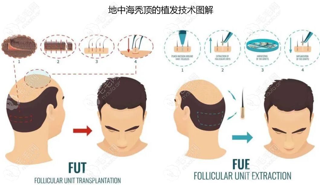 地中海秃顶植发技术示意图