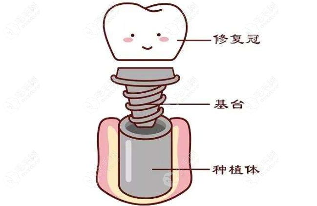 一体冠是植体牙冠基台均为原厂