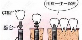 种植牙是不是一体冠要贵一些,与钛支架的价格比便宜万把块