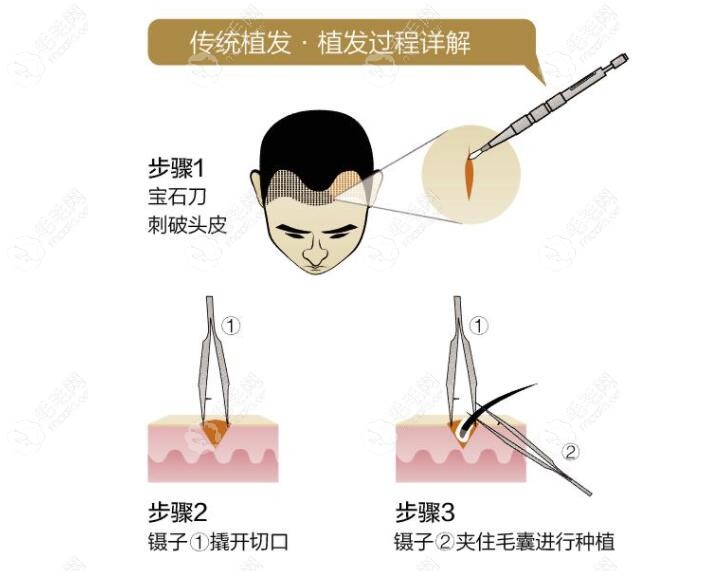 植发过程中的各种技术