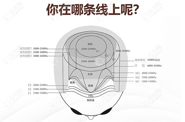 O型脱发等级图以及植发价格