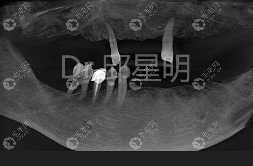 做全口牙前的CT照