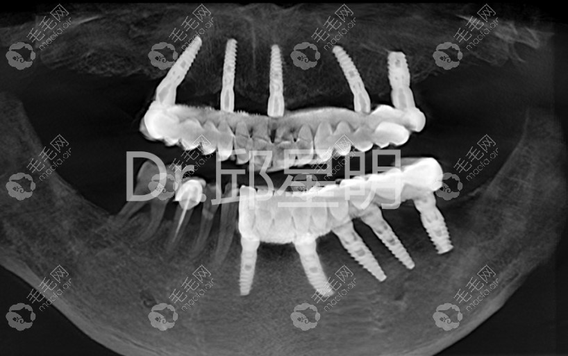 全口上下各种植5颗种植体满口咬合