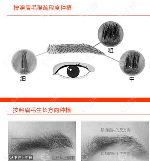 眉毛种植用fut还是fue好不光看植眉的价格还要看技术区别