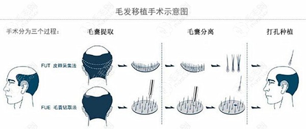 眉毛种植用fut还是fue好可以看技术区别