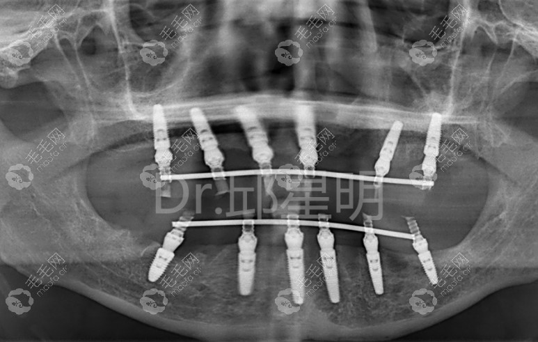 满口种植牙上6下6