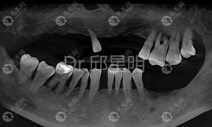 52岁王叔全口种植牙病例术前