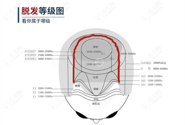 U型发际线的脱发面积及植发毛囊单位数量示意图