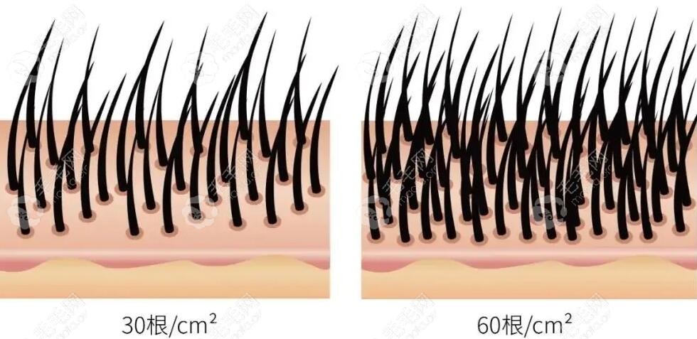 植发30根和60根对比图