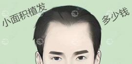 小面积植发大概多少钱可不止种植头发5平方厘米的价格