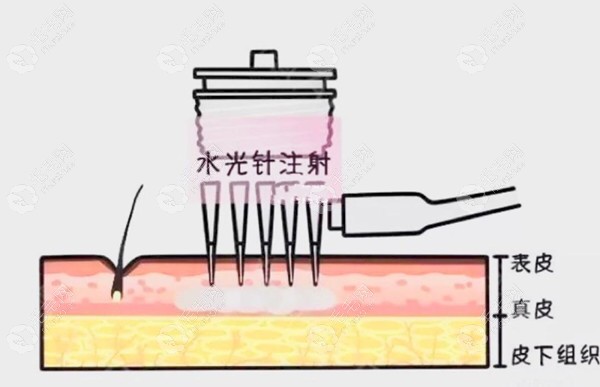 纳米微针生发疗法示意图