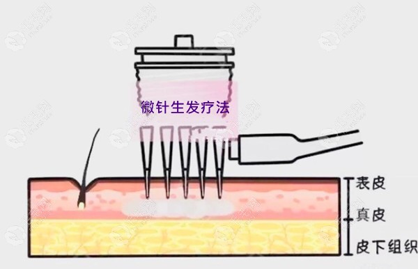 微针能激活头皮示意图