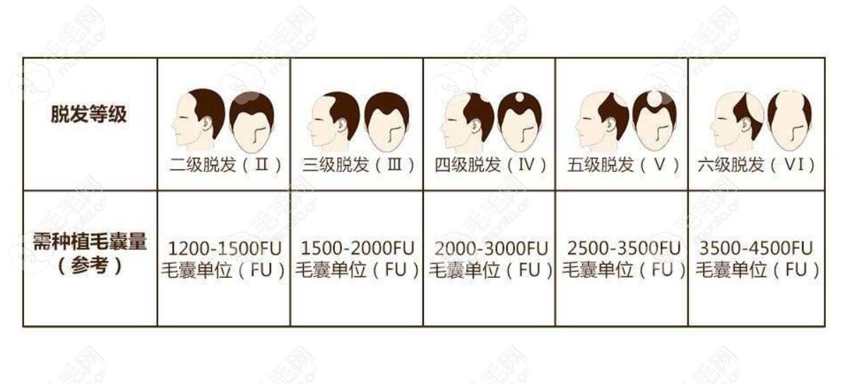 脱发的不同等级及价格