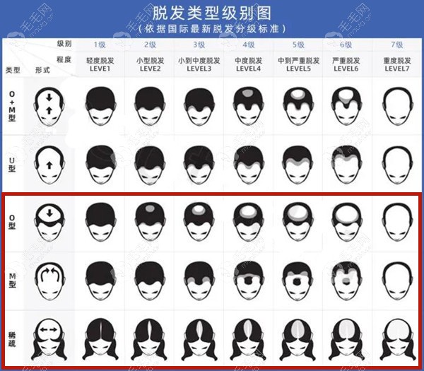 哇！m型脱发和o型脱发/头顶稀疏的区别不止在于脱发原因