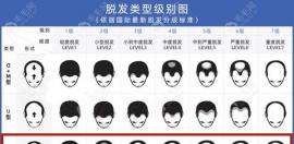 哇！m型脫發(fā)和o型脫發(fā)/頭頂稀疏的區(qū)別不止在于脫發(fā)原因