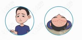 漳州植发手术的费用明细中2000和3000个毛囊单位的价格竟相同