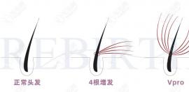 物理增发6000/8000根需要钱1万多,没有长头发的地方是不能接的