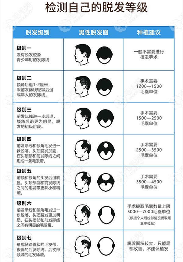 脱发等级对照表