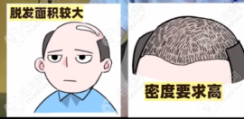 明細(xì)1覽表說清清遠(yuǎn)植發(fā)費(fèi)用多少錢及不同程度人工植發(fā)價(jià)格
